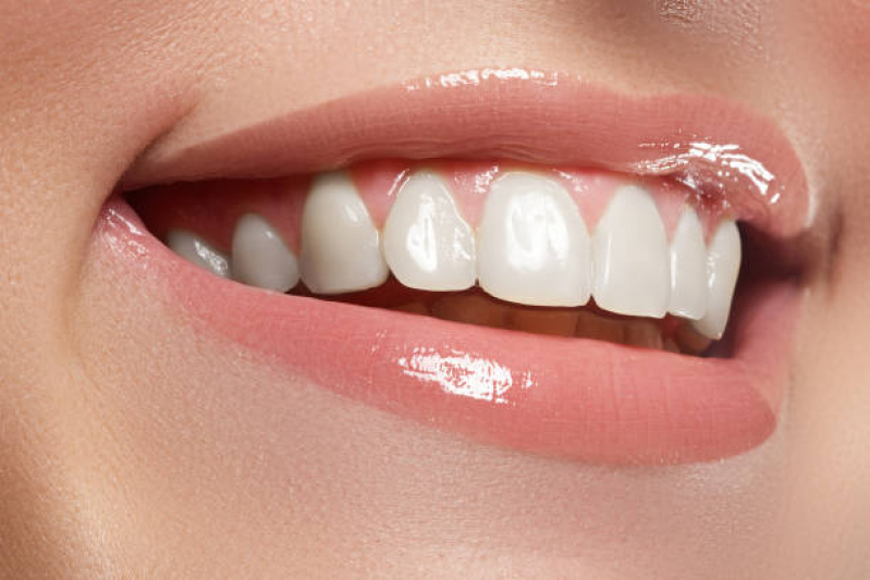 Lente de Contato para Os Dentes Marcar Berrini - Lente de Resina nos Dentes