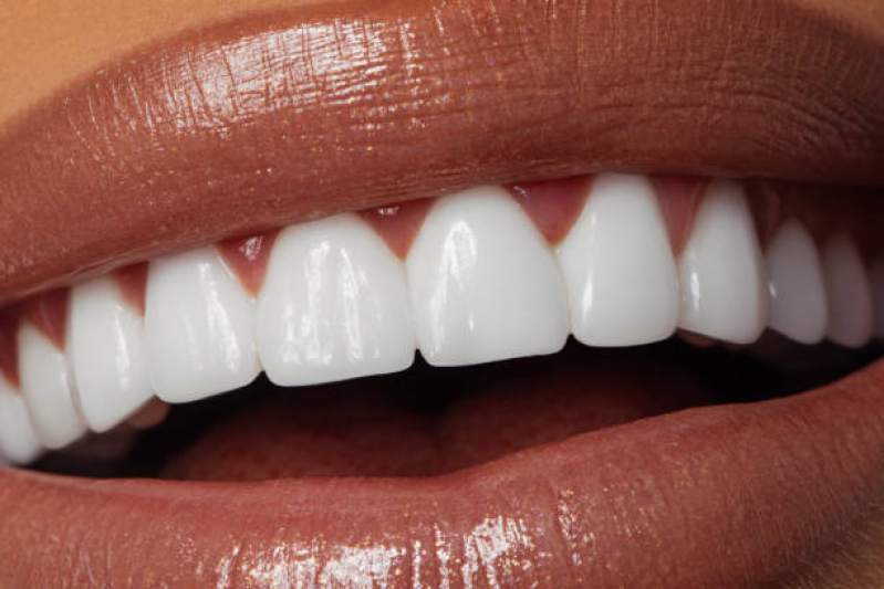 Lente de Porcelana para Dentes Marcar Portal do Morumbi - Lente de Contato Dental Ipiranga