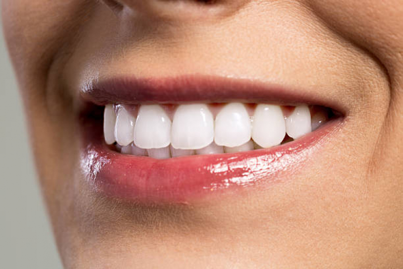 Lente Dental de Resina Marcar Próximo/ Perto FGV - Lente Dental de Resina