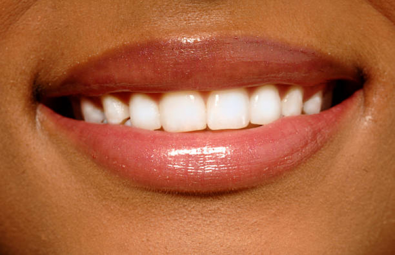 Lente Odontológica Marcar Higienópolis - Lente de Contato Dental Natural
