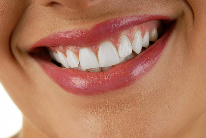 Lente Odontológica Bixiga - Lente Dental de Resina