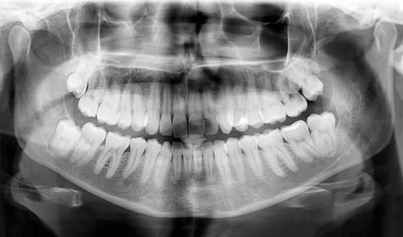 Raio X Odonto Ferreira Viana - Radiografia Digital Odontologia