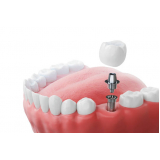 clinica de implante de protese dentaria fixa Santa Cecilia