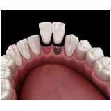 clinica de implante dentário de um dente Bom Retiro