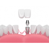 clinica de implante dentario dente da frente Sacomã