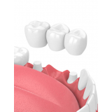 clinica de implante nos dentes Morro dos Ingleses