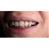 clinica especializada em faceta de porcelana nos dentes Consolação