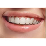 clinica especializada em faceta nos dentes da frente Vila Bayer