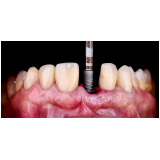 clínica especializada em implante de carga imediata preço metrô Paraíso