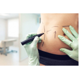 clinica que faz cirurgia de abdominoplastia Alto do Ipiranga