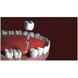 clinica que faz implante de protese dentaria fixa Próximo/ perto ANHEMBI