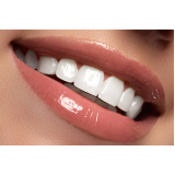 clinica que faz lente de contato dental natural Vila Bayer