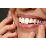 clinica que faz lente de contato para o dente Higienópolis