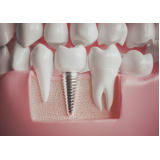 implante de protese dentaria fixa agendar Liberdade