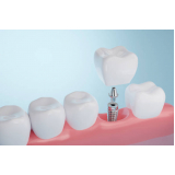 implante de protese dentaria fixa Jardim Caravelas
