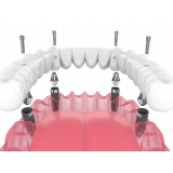 implante de protese dentaria marcar Próximo/ perto Conjunto Nacional