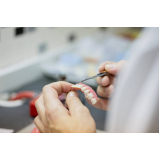 implante de resina dental marcar Bixiga