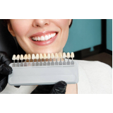 implante de todos os dentes agendar Ipiranga