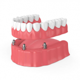 implante dentário carga imediata preço Planalto Paulista