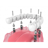 implante dentário completo valor agendar Centro de São Paulo