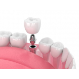 implante dentário de porcelana agendar Sé