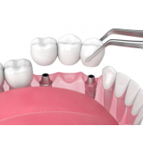 implante dentário de porcelana marcar Vila Sta Catarina