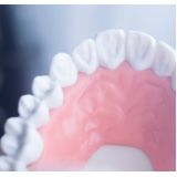 implante dentário de porcelana Consolação