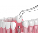 implante dentário de um dente marcar Parque da Mooca