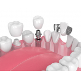 implante dentário de um dente Socorro