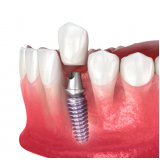 implante dentario dente da frente marcar Vila Bayer