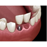 implante dentario dente da frente Santo Amaro