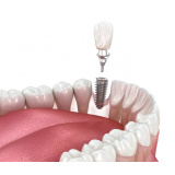 implante dentário fixo marcar Vila Bayer