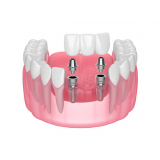 implante dentário inferior agendar Vila Bayer
