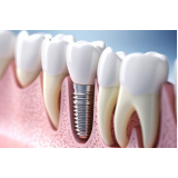 implante dentário inferior total Chácara Pouso Alegre