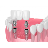 implante dentário inferior Jardim Internacional