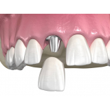 implante dentario na frente marcar Vila Dom Pedro I