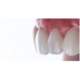 implante dentário superior marcar Vila Independência