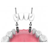 implante dentário Glicério