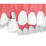 implante nos dentes marcar Vila Helena