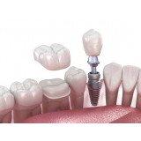 Implante Dentario com Enxerto