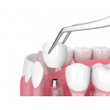 Implante Dentário Ipiranga