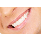 lente de contato dental natural Higienópolis