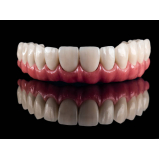 onde fazer implante dentário completo valor Cambuci