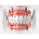 prótese fixa sobre implante anterior orçamento Próximo/ perto IBMEC