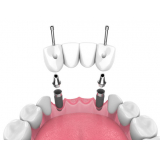 prótese removível sobre implante orçar Vila Clementino