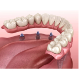 prótese removível sobre implante Vila Andrade