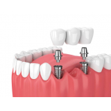 prótese sobre implante inferior Vila Conceição
