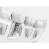 prótese sobre implante orçamento Jardim Anhanguera