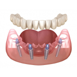 prótese sobre implante orçar Indianópolis