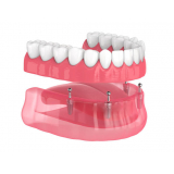 Implantes Dentários Fixos